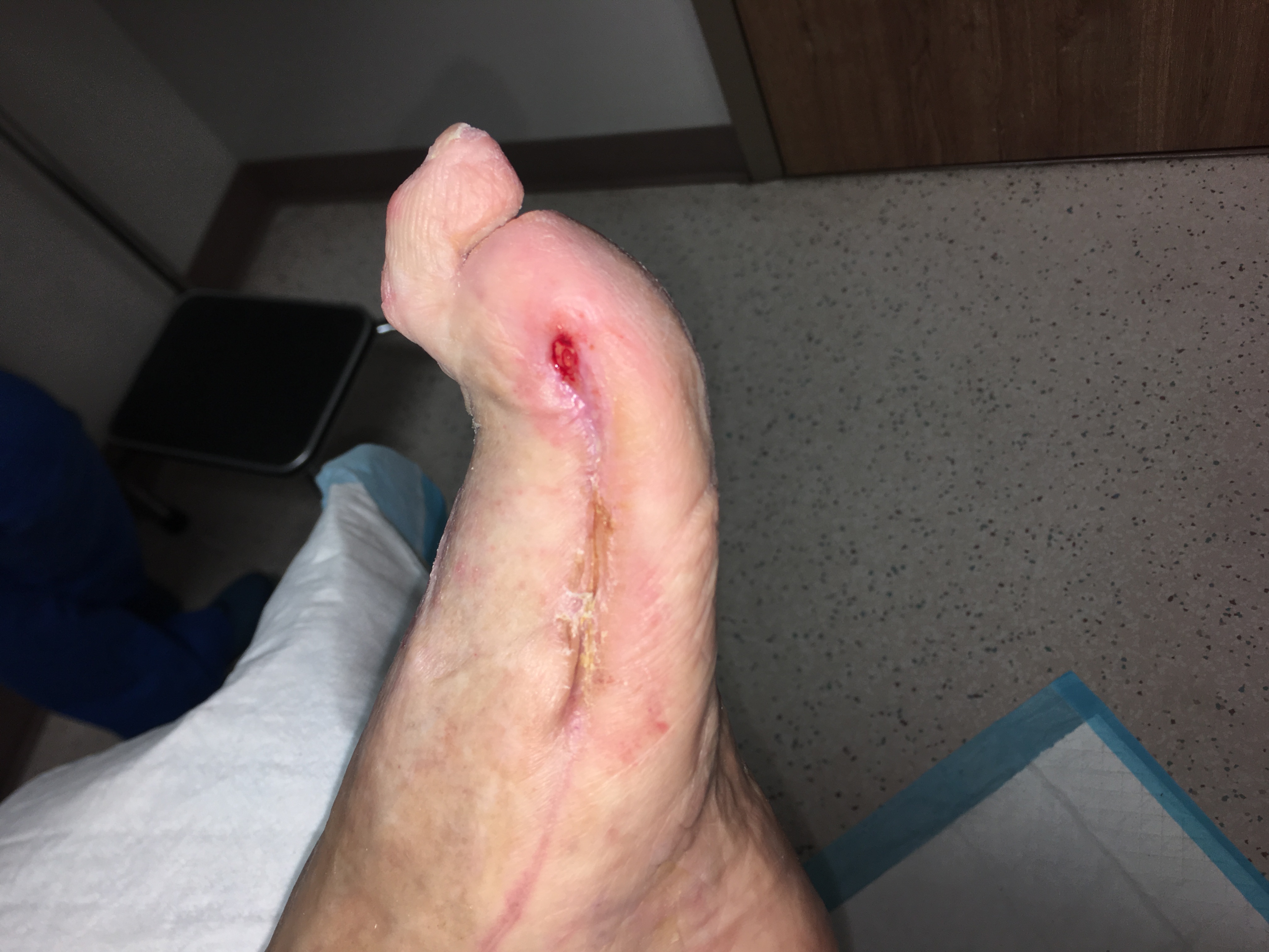 Surgical wound late-stage healing